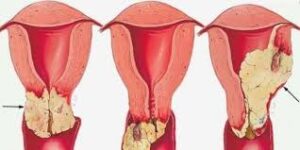 سرطان عنق الرحم والحمل